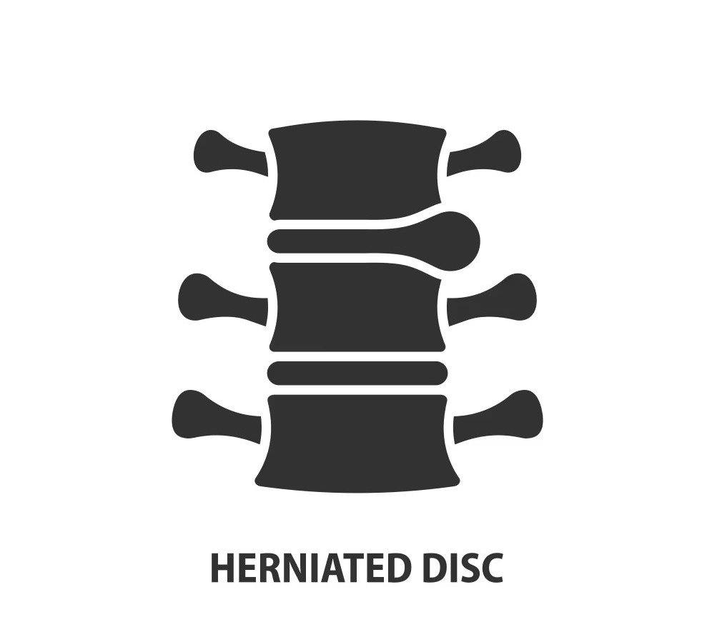 Spinal Disk Herniation